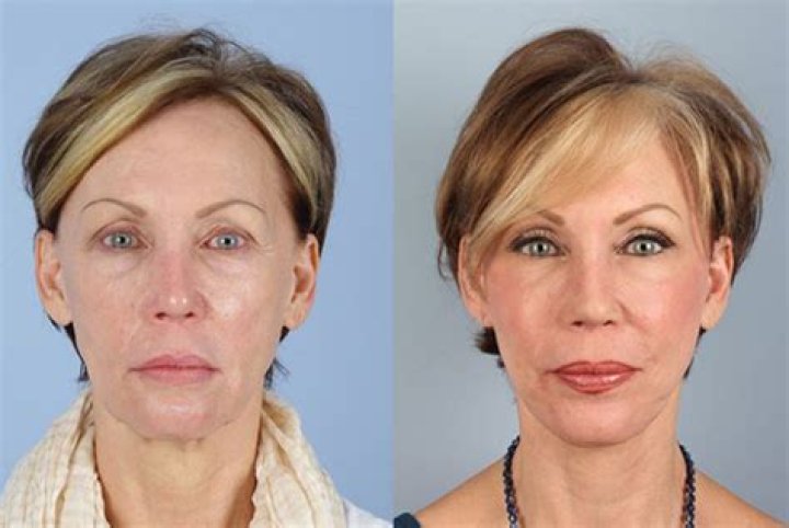 Is Botox, A Facelift, And Rhinoplasty The Reason Behind The Actress’s Ageless Beauty?